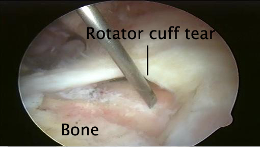 Open Rotator Cuff Repair - St. George Surgical Center