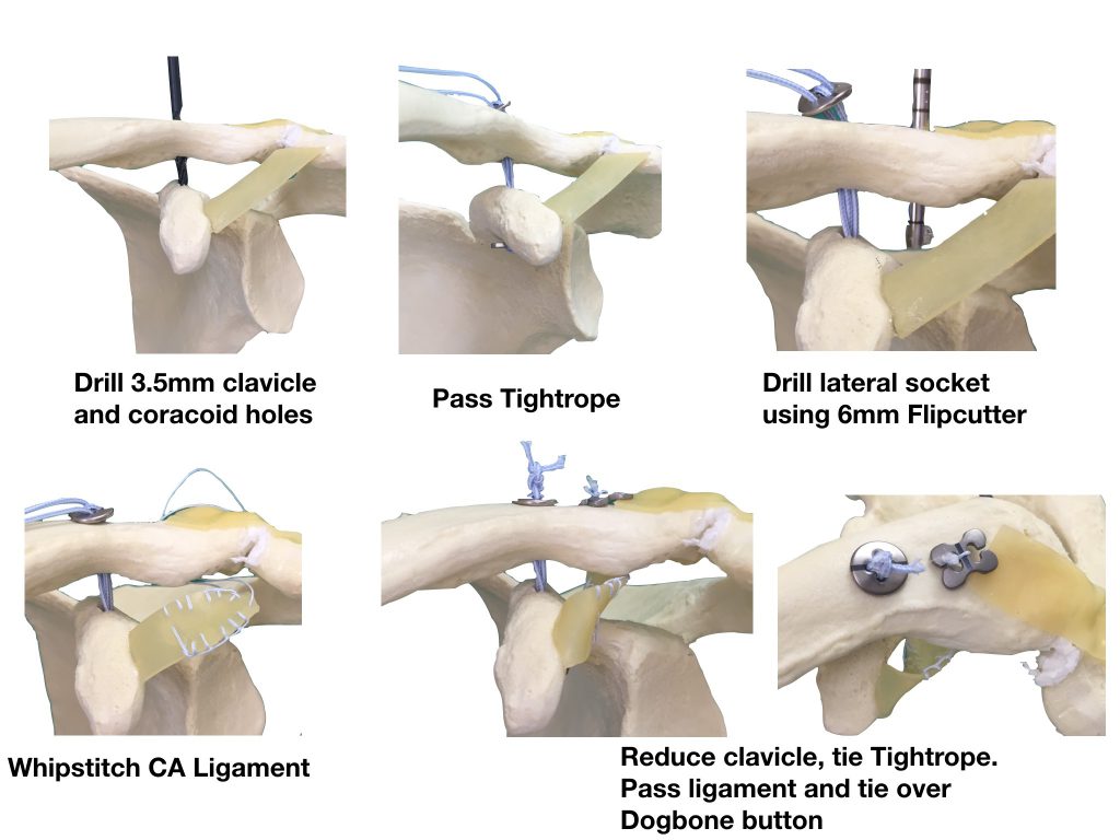 Acromioclavicular Joint Stabilisation DELAYED CHRONIC St George s 